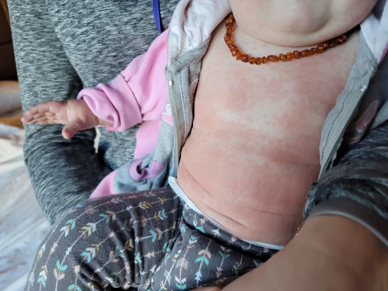 ‘She was inconsolable’: Baby suffers from rash after time in Kelowna hotel pool