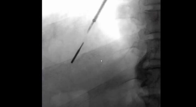 Man accidentally inhales drill bit during trip to dentist