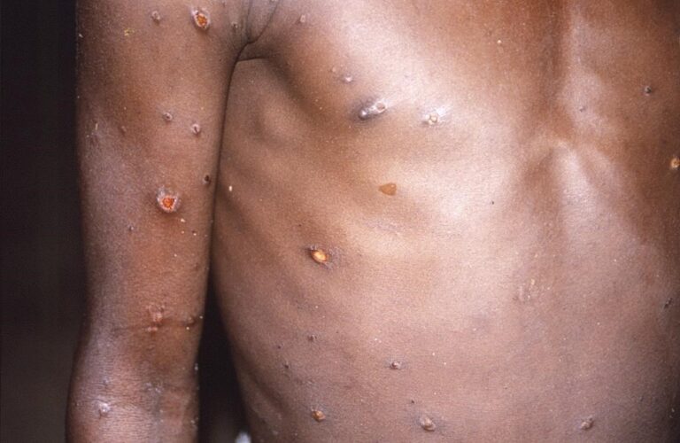 3 more monkeypox cases confirmed in Quebec, bringing Canadian total to 5