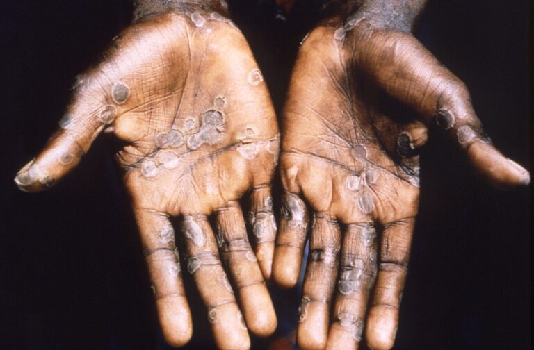 Monkeypox: England detects 36 more cases, bringing total to 56