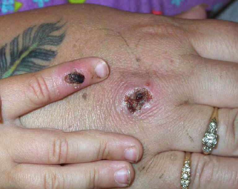 Quebec confirms cases of monkeypox now at 15