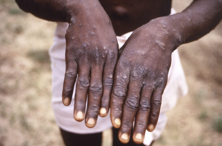 Physical distancing recommended amid monkeypox spread in Canada, Njoo says