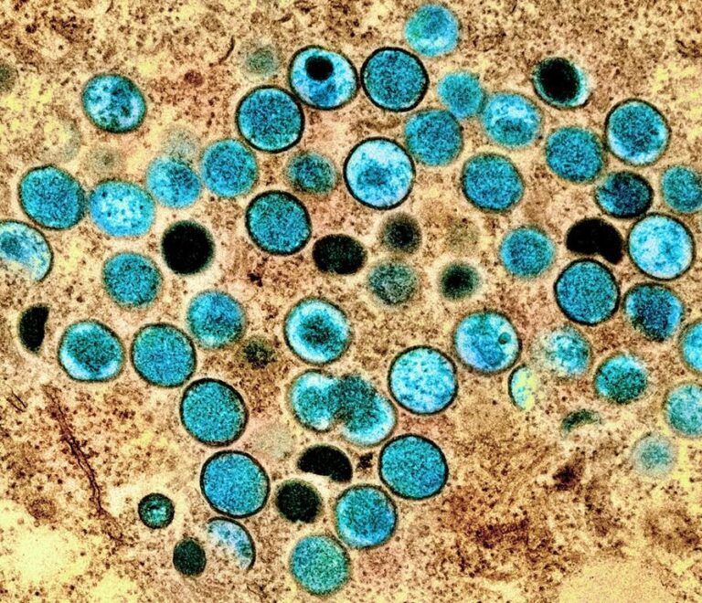 Monkeypox spread in U.S. could become entrenched as new STD, experts say