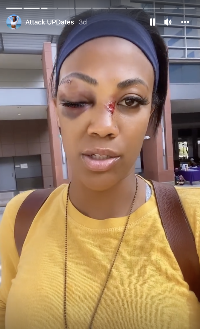 Olympic medallist Kim Glass left bloodied with swollen eye after attack in L.A.