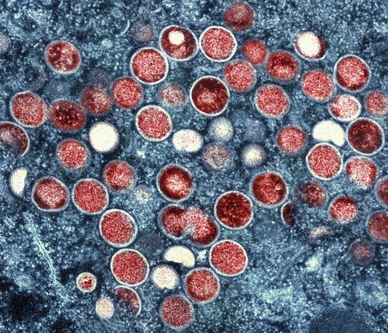 Spain reports 2nd monkeypox death as virus continues to spread in Europe