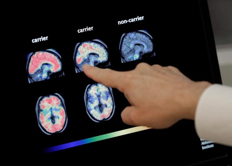 Leading Alzheimer’s theory undermined: Did tampering waste 16 years of research?