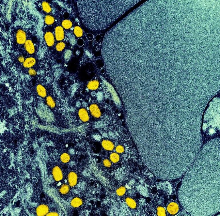 Montreal public health investigating ‘probable’ monkeypox case involving child