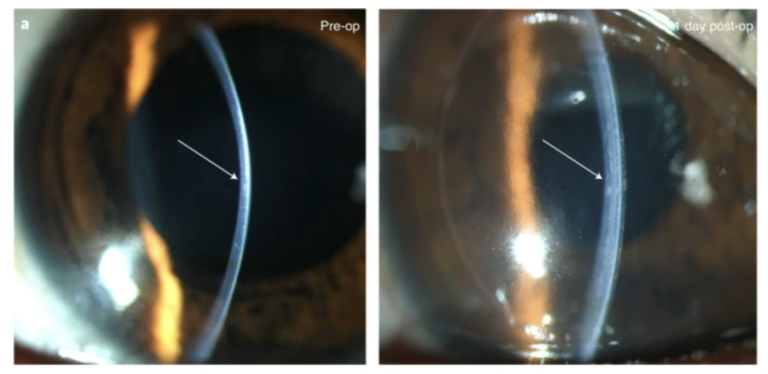 Eye implant made from pig skin restored sight in blind people, according to study