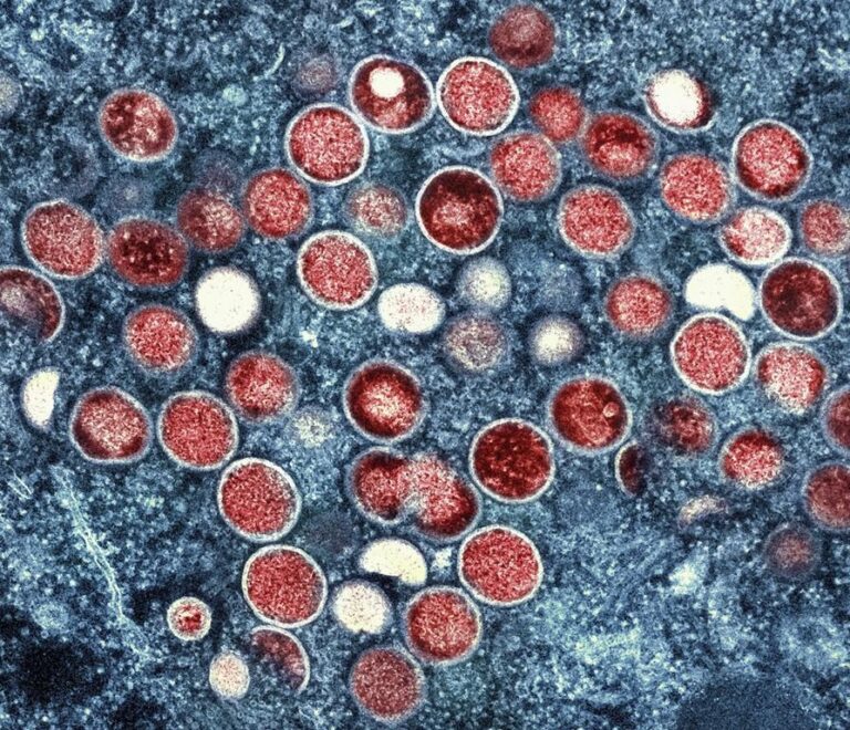 Monkeypox death reported in California, believed to be 1st in U.S.