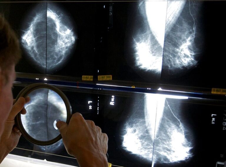 15 patients in N.L. require followup as review of thousands of mammograms continues