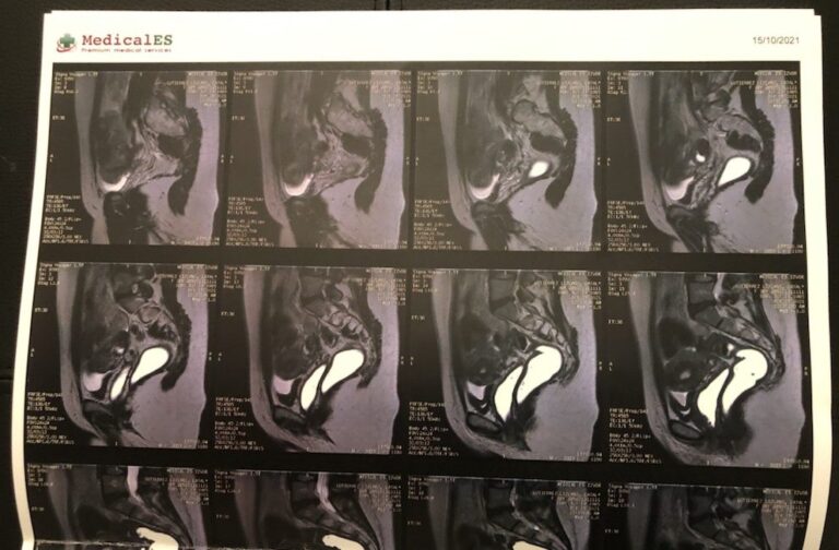 Endometriosis: Why Canadian women are flocking to a clinic in Bucharest for surgery