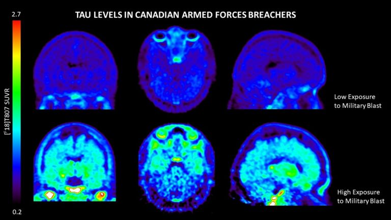 Veterans and mental illness — How Canadian research could unlock the mysteries of the brain