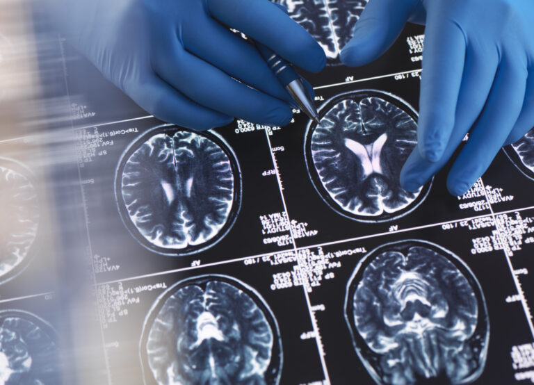 More women develop Alzheimer’s than men. This app wants to close that gap