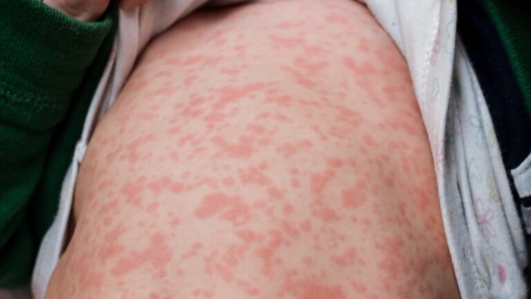 Measles has exploded in Texas, but state could let more kids skip vaccines