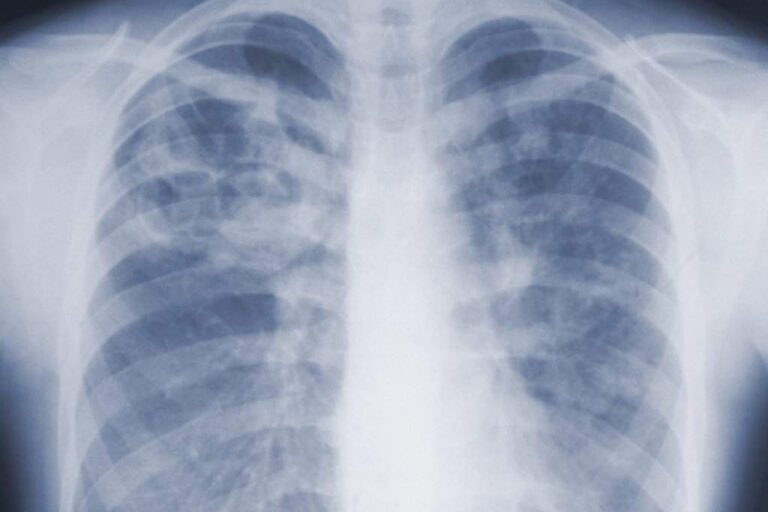 Are you underestimating mold-related illness? What U.S. study says